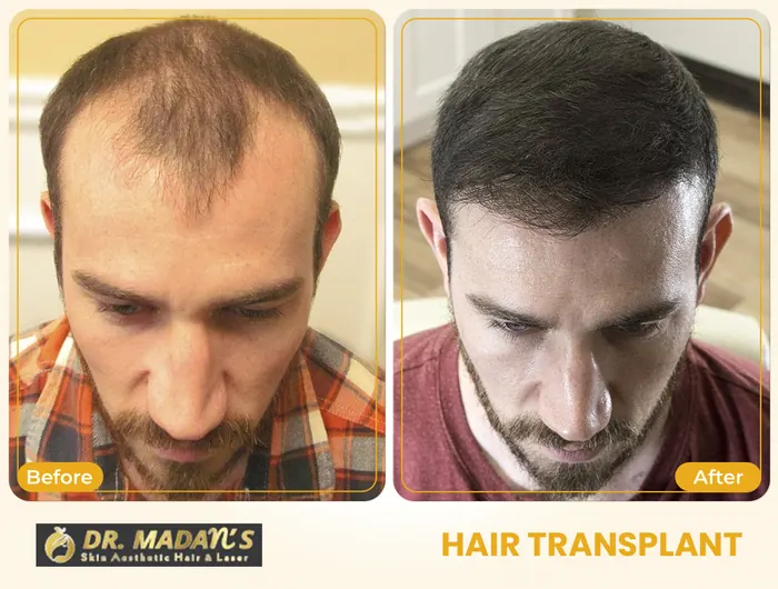 Hair transplant before and after result 3 at Dr Madan Aesthetics